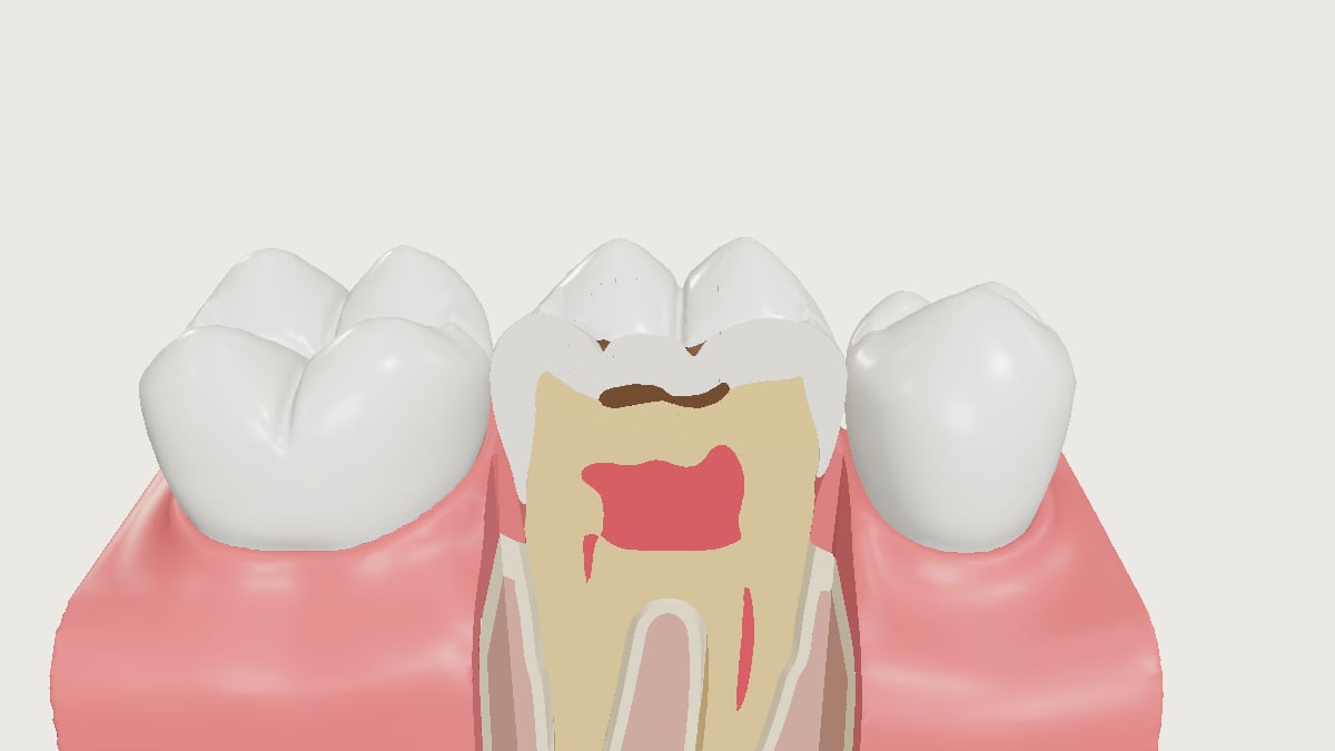 A lower molar cut in section between its neighbours, the brown decay spreading under the fissure toward the pulp.